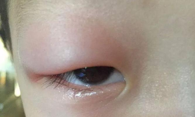探讨狗腿水肿的成因及治疗方法（为你解析狗腿水肿的根本原因和有效治疗方式）