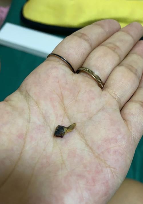 正常耳屎的样子和特征（探秘正常耳屎的健康秘密）