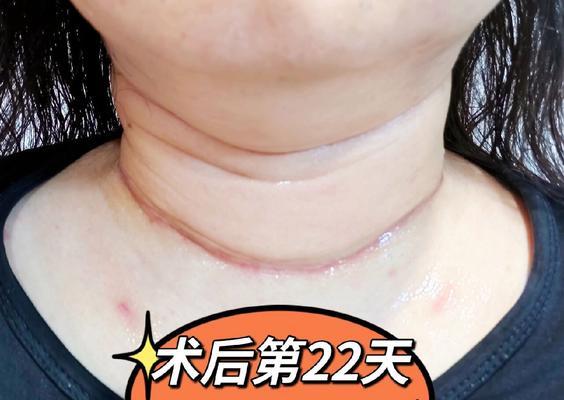 软痂和硬痂，了解不同的牙结石类型（软痂与硬痂的区别与防治方法）