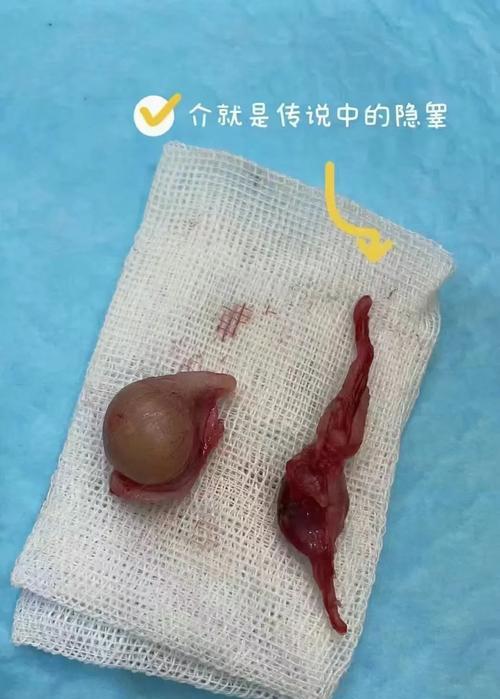 隐睾症的治疗方法与绝育问题（隐睾症的治疗方法及对绝育的影响）